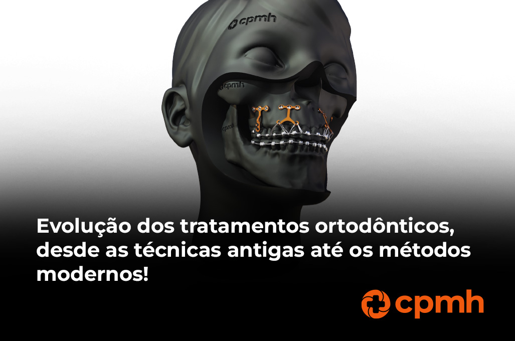 A imagem mostra uma ilustração em 3D de um crânio humano, destacando o uso de placas de ancoragem esquelética na ortodontia. As placas estão fixadas no osso maxilar, e o aparelho ortodôntico é visível nos dentes. O crânio está parcialmente sombreado, com detalhes das estruturas ósseas e das placas bem destacados. No topo da imagem, há o logotipo da CPMH, e na parte inferior, em destaque, há o texto: "Evolução dos tratamentos ortodônticos, desde as técnicas antigas até os métodos modernos!" acompanhado do logotipo da CPMH no canto direito inferior. A imagem reflete a evolução e modernização dos tratamentos ortodônticos.